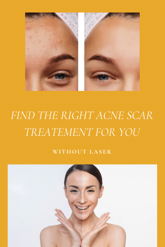 Find The Right Acne Scar Treatment For You With Without Laser